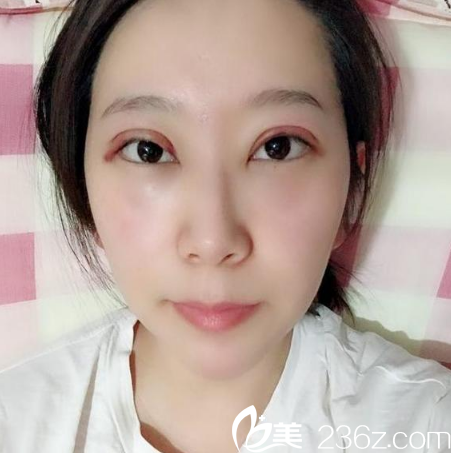 东莞南城西妃双眼皮做的好 东莞南城西妃双眼皮做的好