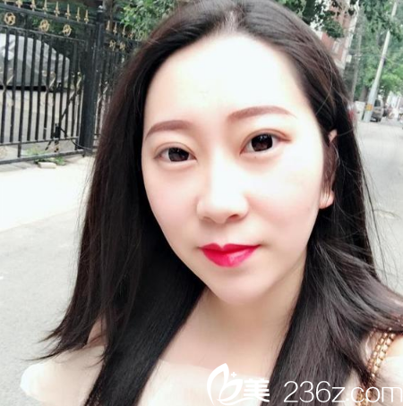 东莞西妃刘波院长做的双眼皮效果 东莞西妃刘波院长做的双眼皮效果