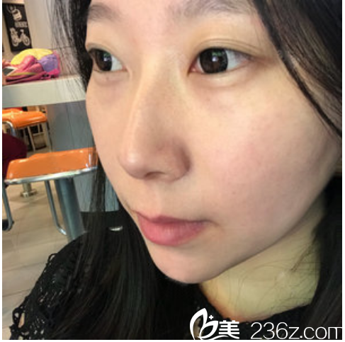 东莞南城西妃整形医院做双眼皮怎么样 东莞南城西妃整形医院做双眼皮怎么样