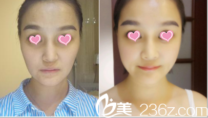 北京<!--<i data=20240703-sp></i>-->面部脂肪填充