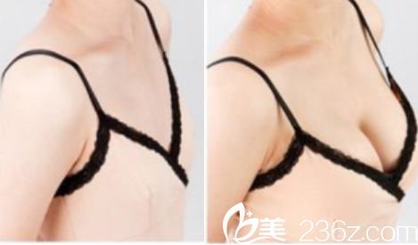 北京<!--<i data=20240703-sp></i>-->脂肪丰胸