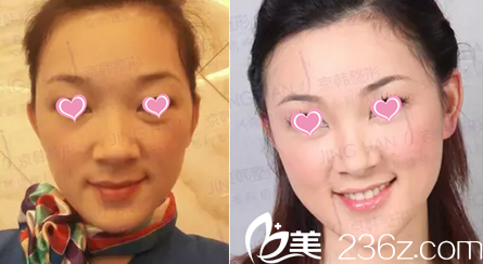 北京京韩面部脂肪填充