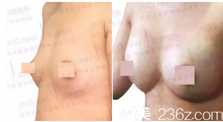 北京京韩脂肪丰胸