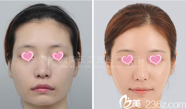 北京润美玉之光面部脂肪填充