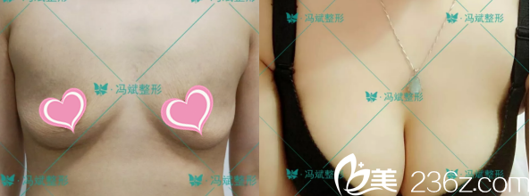 <!--<i data=20240703-sp></i>-->脂肪丰胸