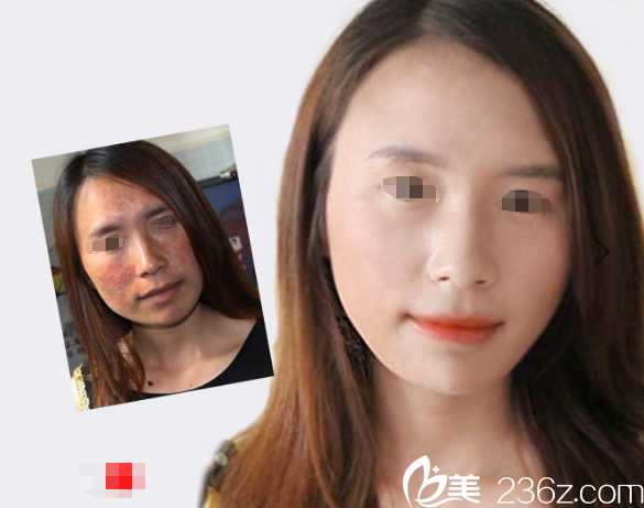 淮安华美皮秒激光祛斑价格