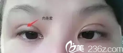 割双眼皮手术后出现肉条