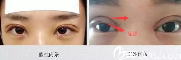 如何区分双眼皮手术后的真假性肉条