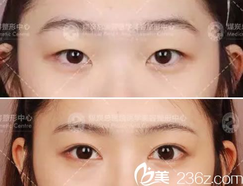 做双眼皮成功案例效果