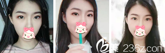 济源割双眼皮一般多少钱？分享我找济源萍做的5000元双眼皮术后恢复图