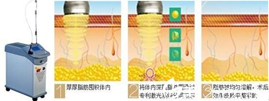 雅芳亚采用CGF自体脂肪移植技术