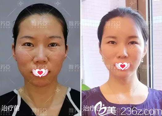 石家庄雅芳亚自体脂肪填充案例