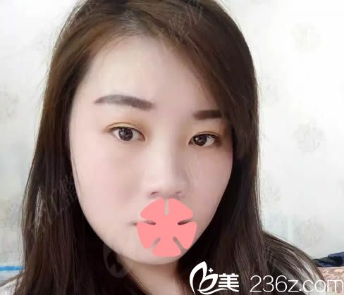 在福州台江整形医院隆鼻术前照 在福州台江整形医院隆鼻术前照