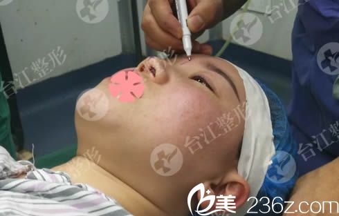 鼻整形前设计方案 鼻整形前设计方案