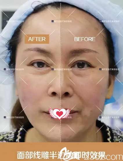 线雕术前后面部对比 线雕术前后面部对比