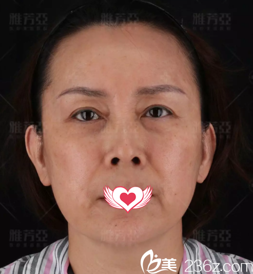 术前面部皮肤松弛下垂 术前面部皮肤松弛下垂