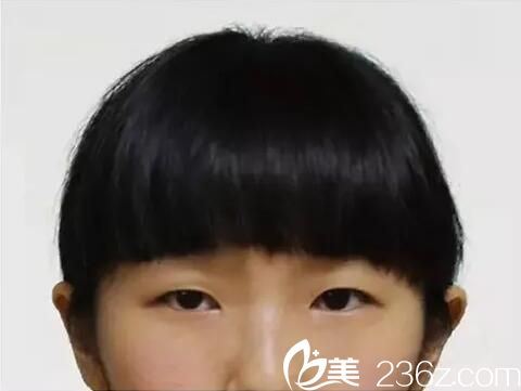 术前照片 术前照片