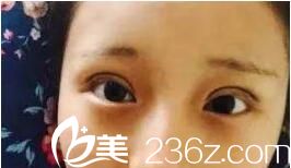 术后两天效果 术后两天效果