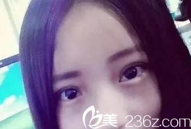 术后7天效果 术后7天效果