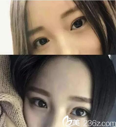 因长久使用双眼皮贴造成眼睑松弛 在宜昌前卫做了个双眼皮手术仅需15天就解决了 