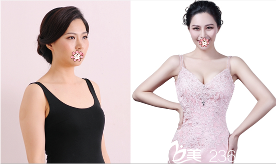 成都精美源整形周斌自体脂肪丰胸案例 成都精美源整形周斌自体脂肪丰胸案例