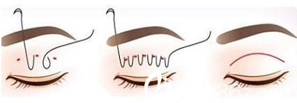 那些情况需要做双眼皮修复