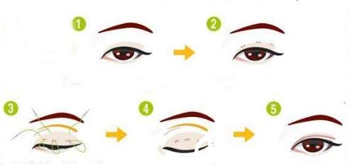 全切双眼皮修复好不好？