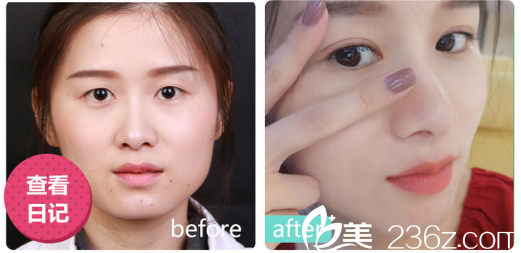 深圳美莱林登文做的双眼皮<span style= 深圳美莱林登文做的双眼皮<span style=