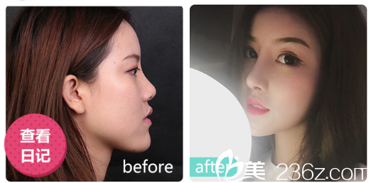 深圳美莱整形医院梁晓健做的隆鼻<span style= 深圳美莱整形医院梁晓健做的隆鼻<span style=