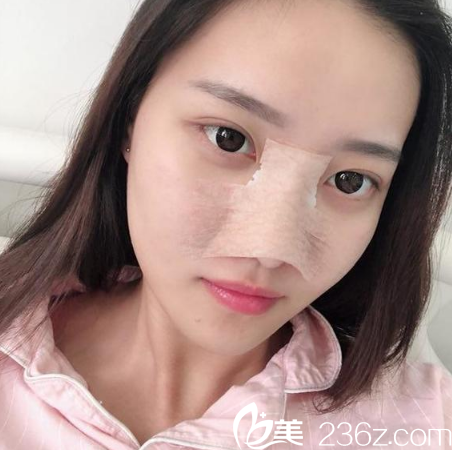 广州粤秀徐士亮做的鼻子术后4天图片