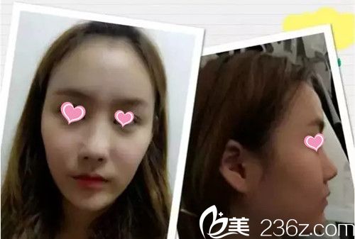 自体脂肪填充全脸手术前 自体脂肪填充全脸手术前