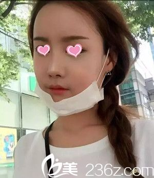 自体脂肪丰苹果肌后13天 自体脂肪丰苹果肌后13天