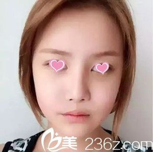 史希杰给我做自体脂肪全脸手术20天了 史希杰给我做自体脂肪全脸手术20天了