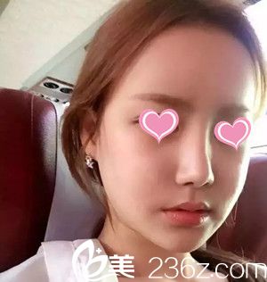 自体脂肪丰鼻唇沟后20天 自体脂肪丰鼻唇沟后20天