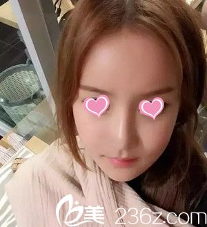 史希杰给我设计的自体脂肪填充方案是：填充额头+太阳穴+苹果肌+鼻唇沟，来看看术后效果