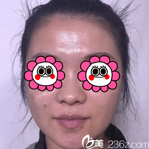 在北京米兰柏羽丽都注射前样子 在北京米兰柏羽丽都注射前样子