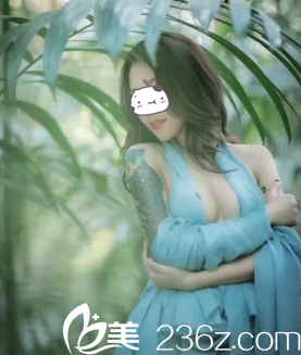 假体隆胸术后1个月胸部完全消肿 假体隆胸术后1个月胸部完全消肿