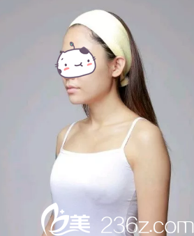 术前胸部平坦 术前胸部平坦