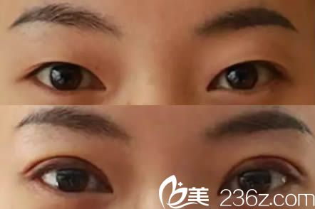 宜宾韩美整形双眼皮案例效果图 宜宾韩美整形双眼皮案例效果图