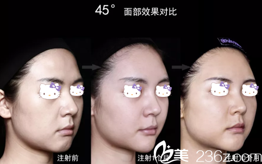 艾莉薇玻尿酸注射真人案例效果对比