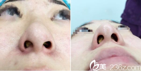 杭州珠儿丽刚做完鼻翼缩小手术照片