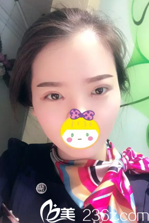 术后3天双眼皮微肿