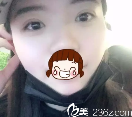 眼综合7天后双眼皮消肿