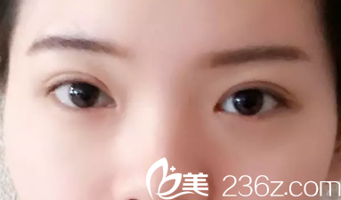 恢复16天后双眼皮慢慢恢复中