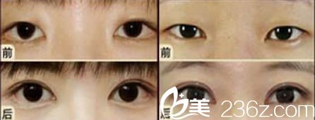 乌鲁木齐伊丽莎白眼综合效果对比图 乌鲁木齐伊丽莎白眼综合效果对比图