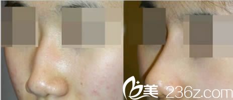 乌鲁木齐伊丽莎白整形医院假体隆鼻效果对比图 乌鲁木齐伊丽莎白整形医院假体隆鼻效果对比图