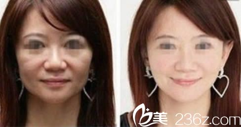 乌鲁木齐伊丽莎白整形面部年轻化案例效果对比图 乌鲁木齐伊丽莎白整形面部年轻化案例效果对比图