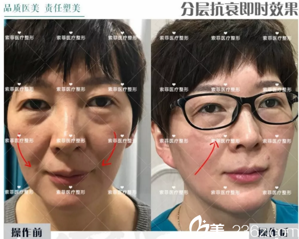 博瑞莱前后对比