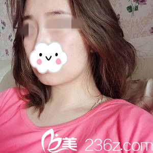 埋线提升前的我 埋线提升前的我