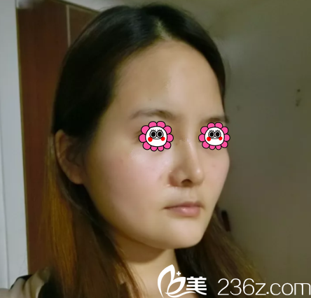 在北京印正山做面部脂肪填充前样子 在北京印正山做面部脂肪填充前样子